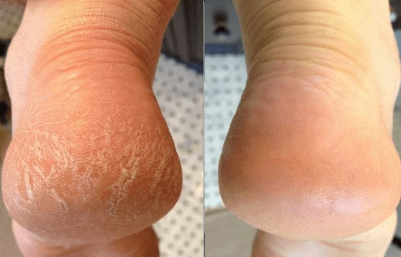 cracked heels