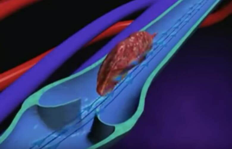 These are the 9 signals your body gives off when you've got a blood clot